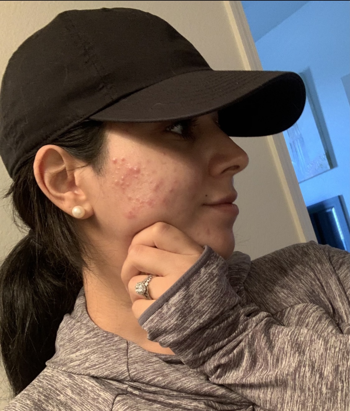 woman with facial cystic acne
