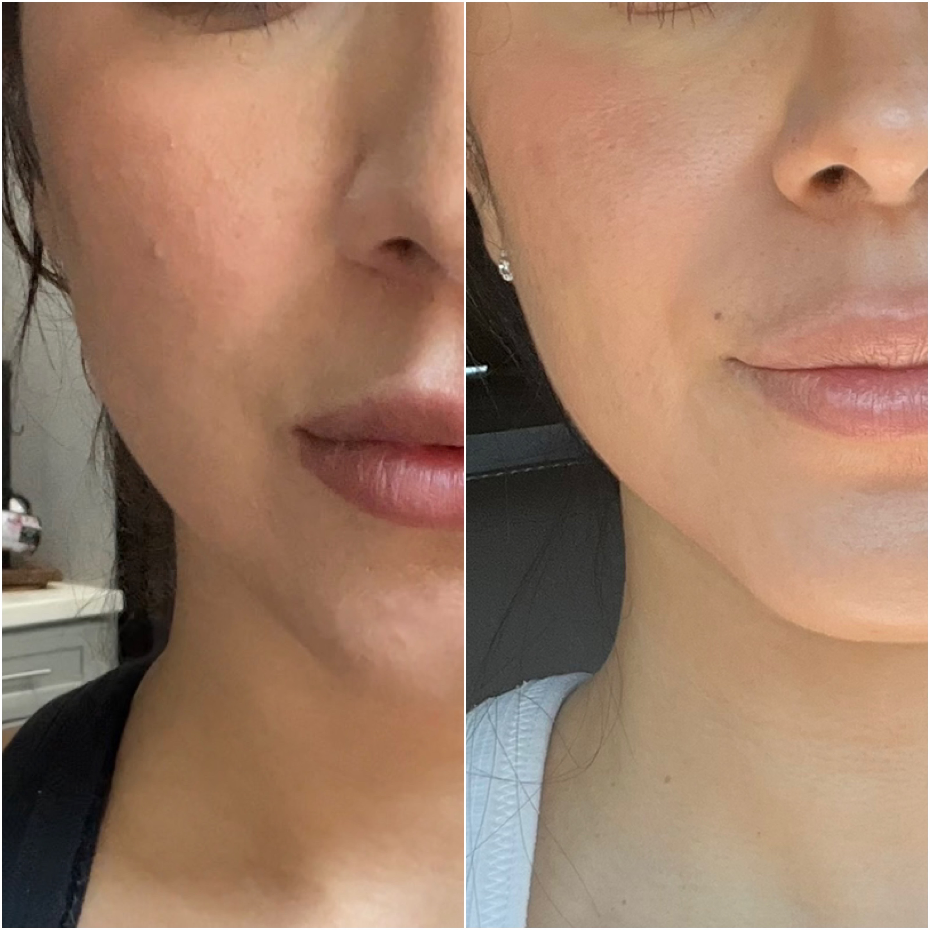 before and after photo of fibroblast cheek treatment