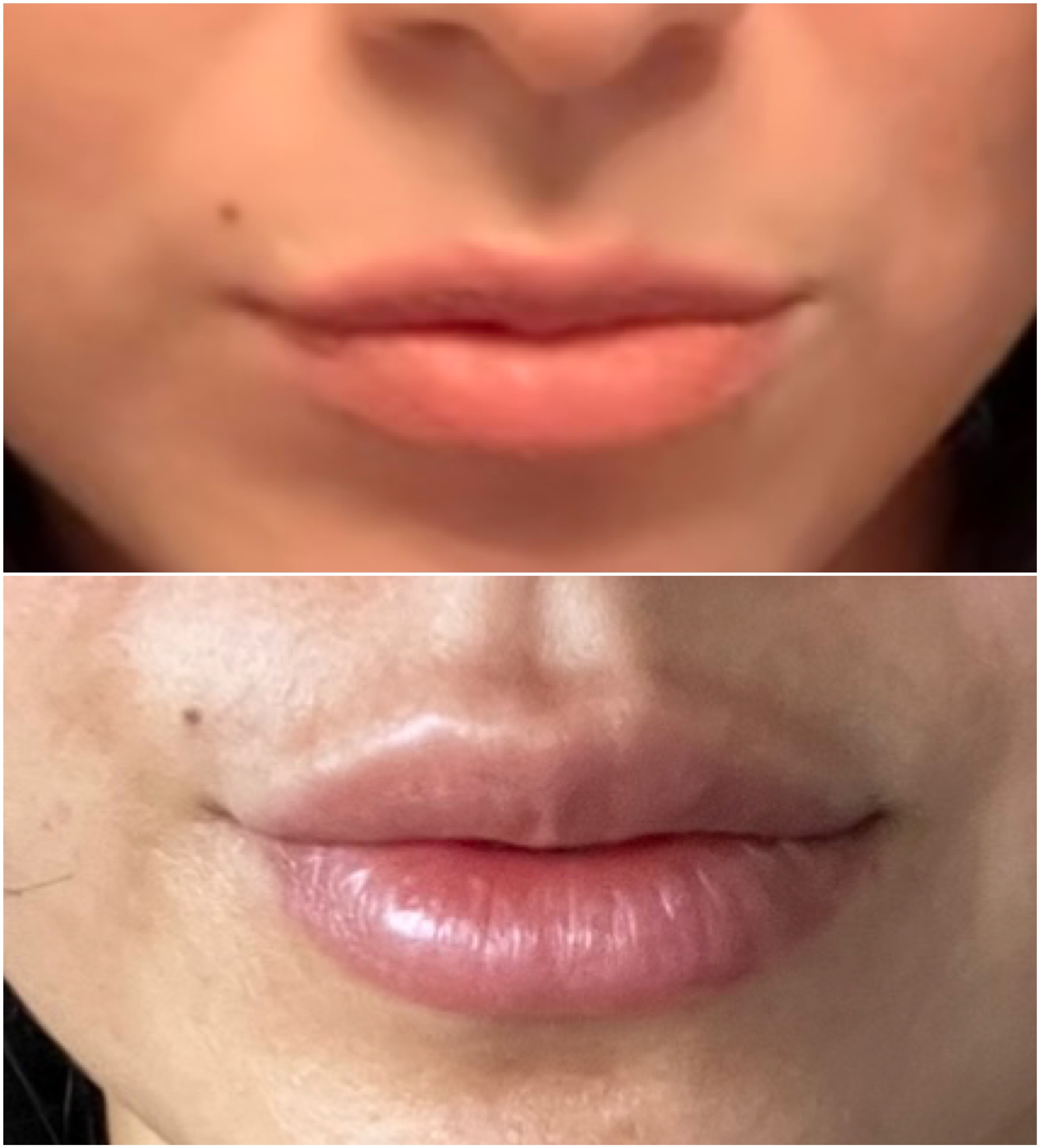 lips before and after lip flip