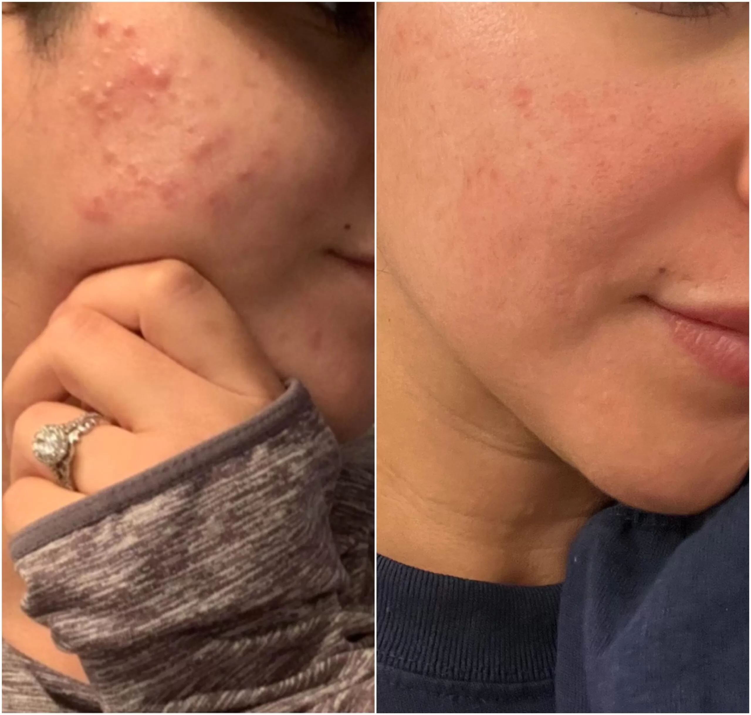 Clear Skin Journey After YEARS of Acne